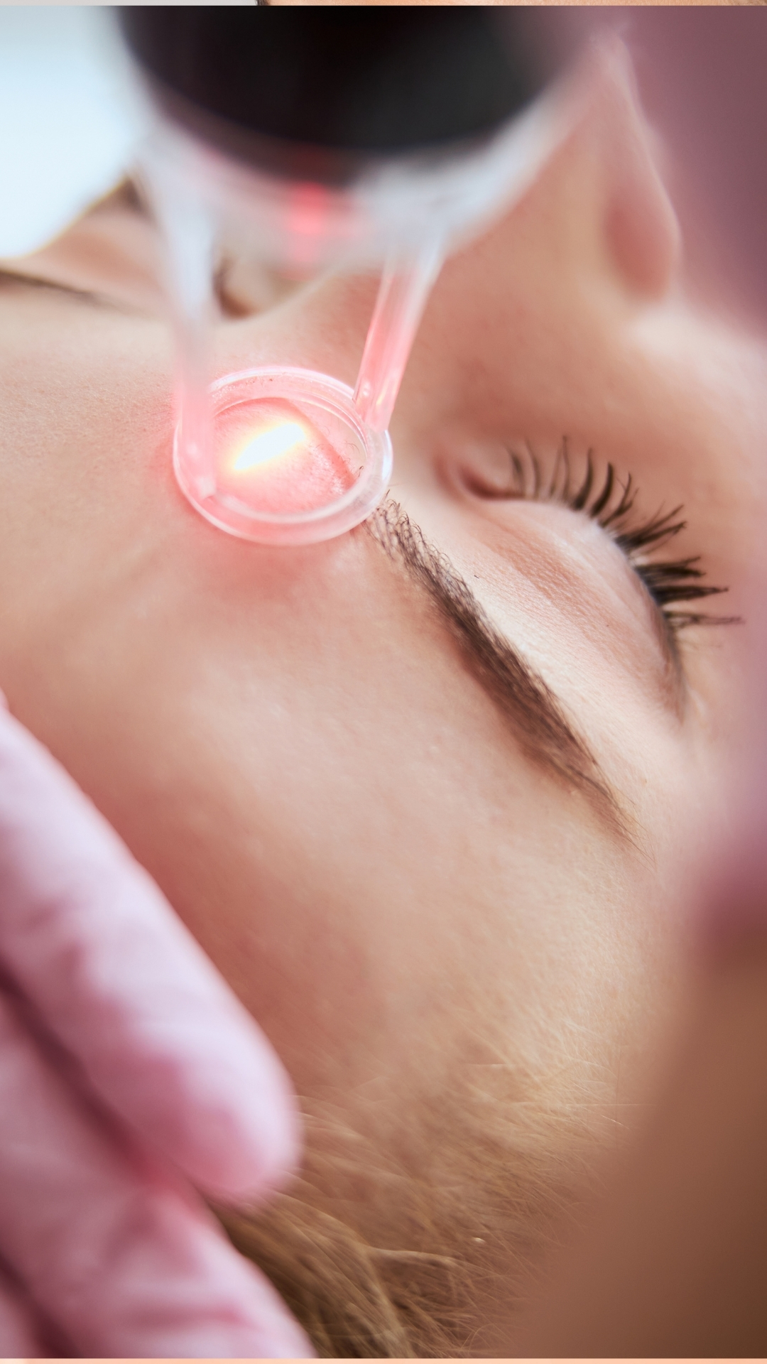 CO2 Laser Behandlung